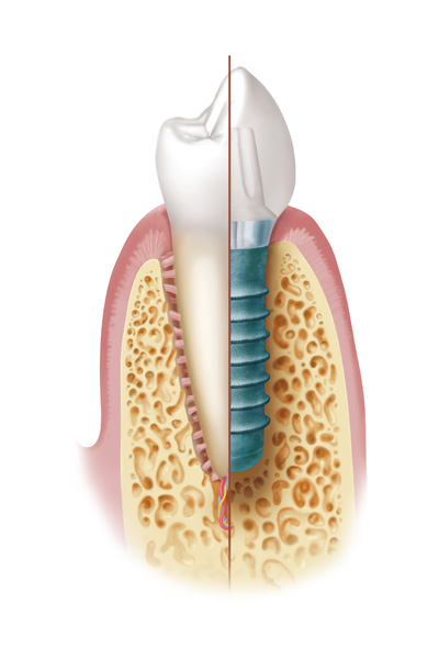 Implantat Illustration