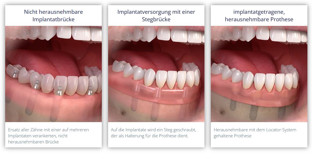 Herausnehmbare, implantatgetragene Prothese oder fest verschraubte Zahnreihe bei vollständig zahnlosem Kiefer